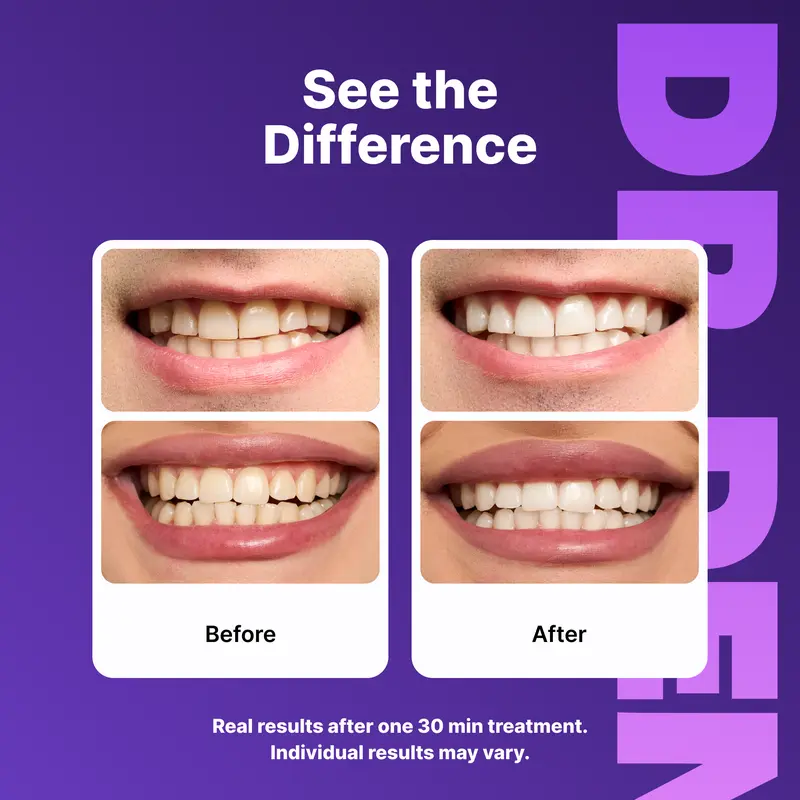 DR.DENT Purple Teeth Whitening Strips – Peroxide-Free, Non-Sensitive, PAP Formula | 7 or 21 Sessions